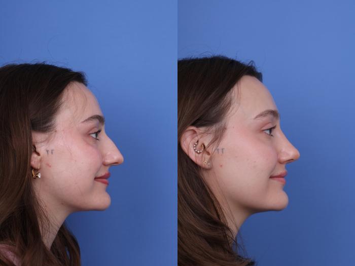 Before & After Rhinoplasty Case 738 Right Smile View in Scottsdale, AZ