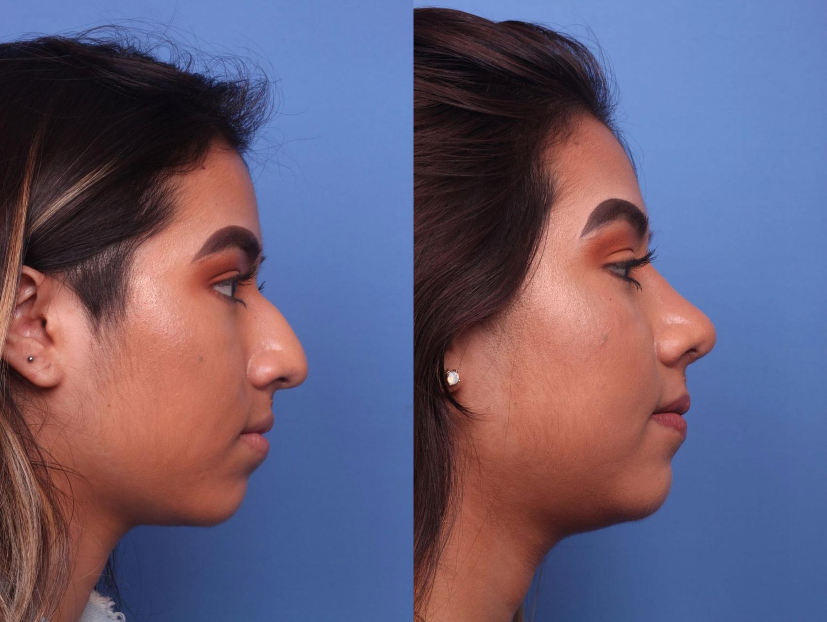 Before & After Rhinoplasty Case 9 View #2 View in Scottsdale, AZ