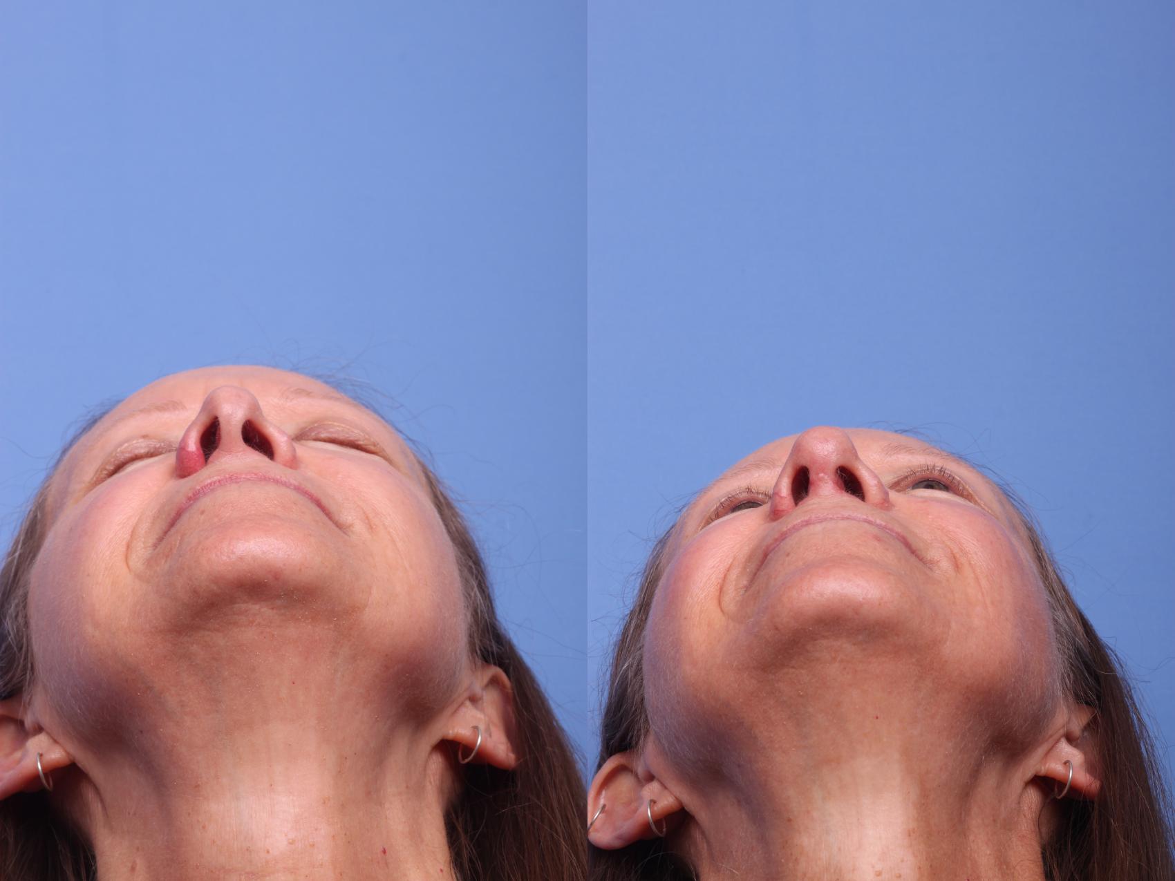 Before & After Rhinoplasty Revision Case 142 View #4 View in Scottsdale, AZ