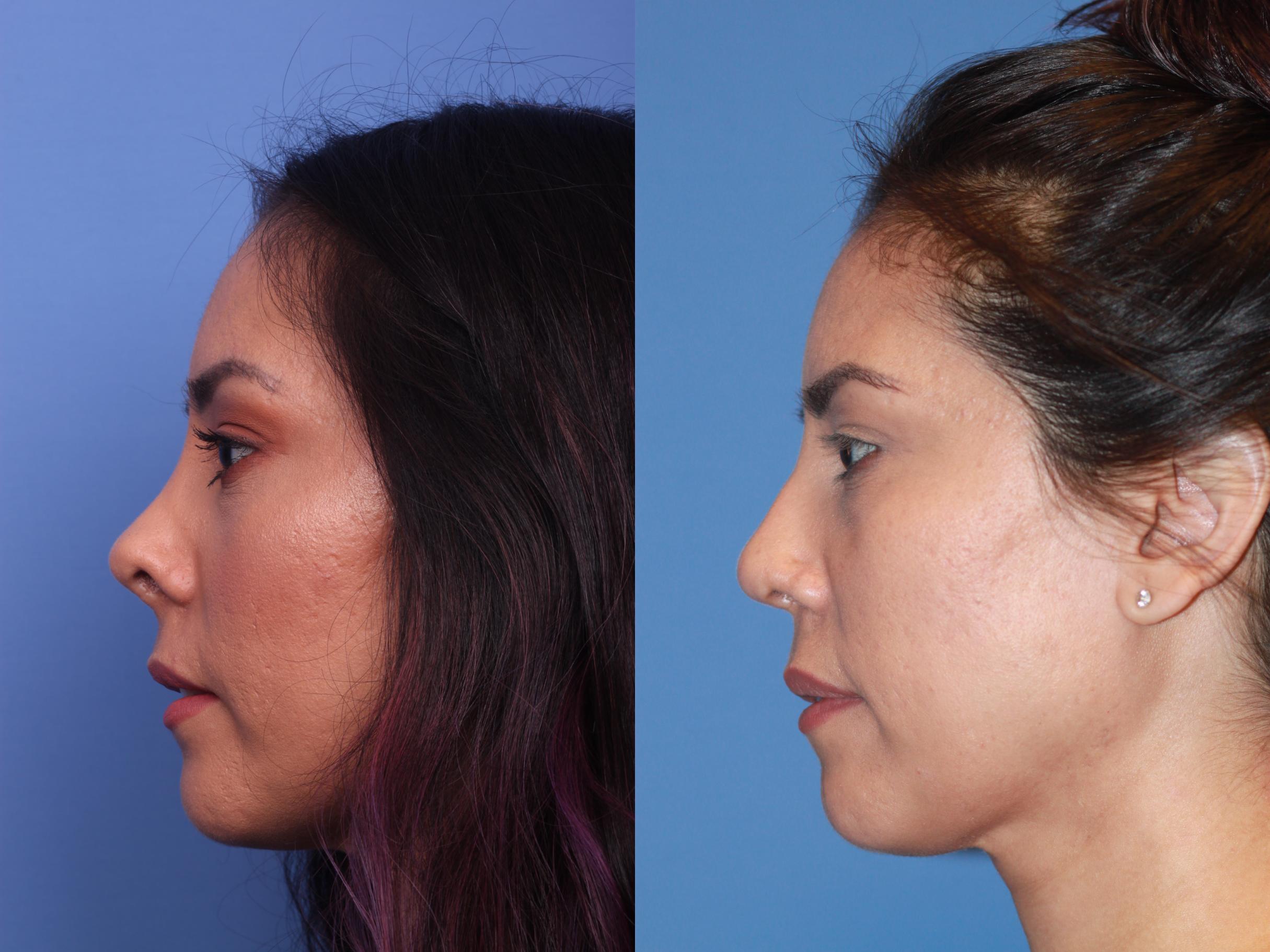 Rhinoplasty (Nose Job) in Toronto - Ford Plastic Surgery