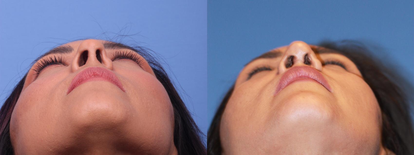 Rhinoplasty Revision Before & After Photo | Scottsdale, AZ | Hobgood Facial Plastic Surgery: Todd Hobgood, MD