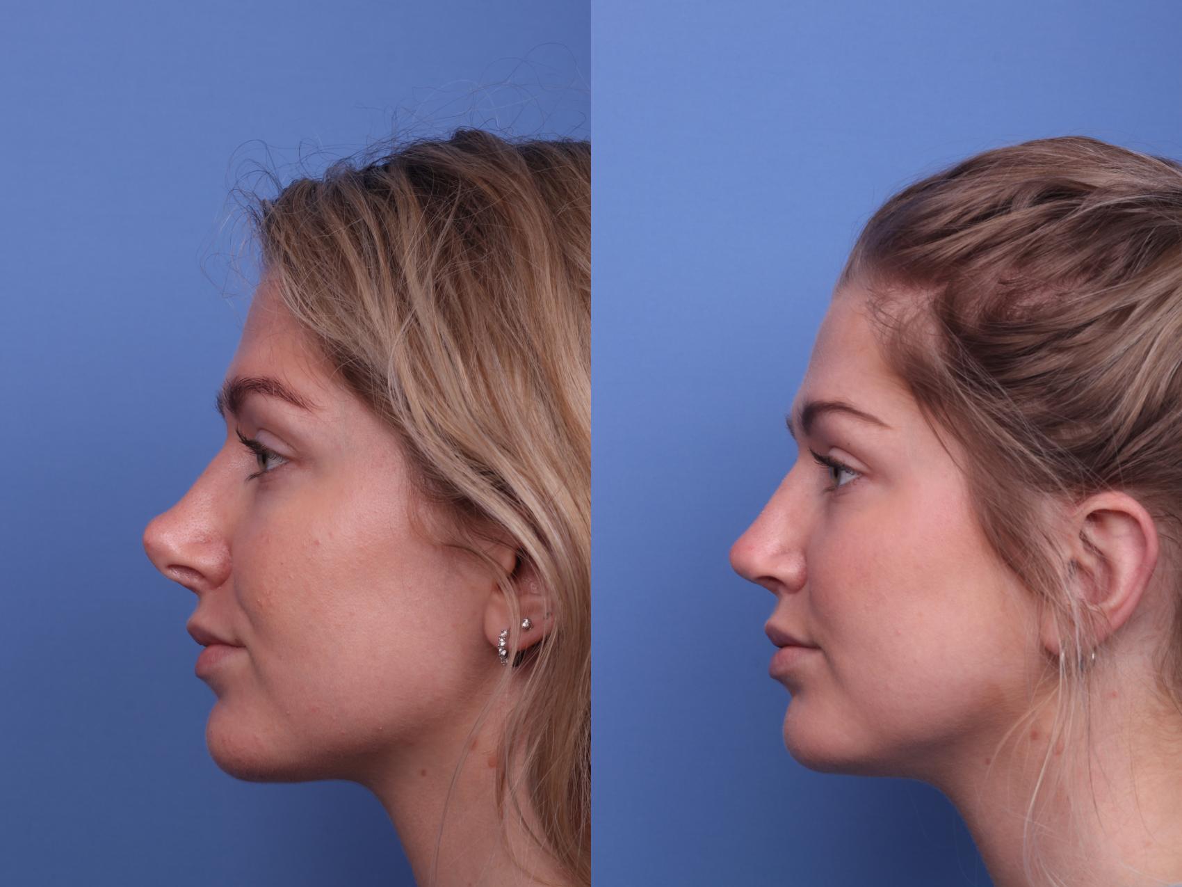 Rhinoplasty Revision Before & After Photo | Scottsdale, AZ | Hobgood Facial Plastic Surgery: Todd Hobgood, MD