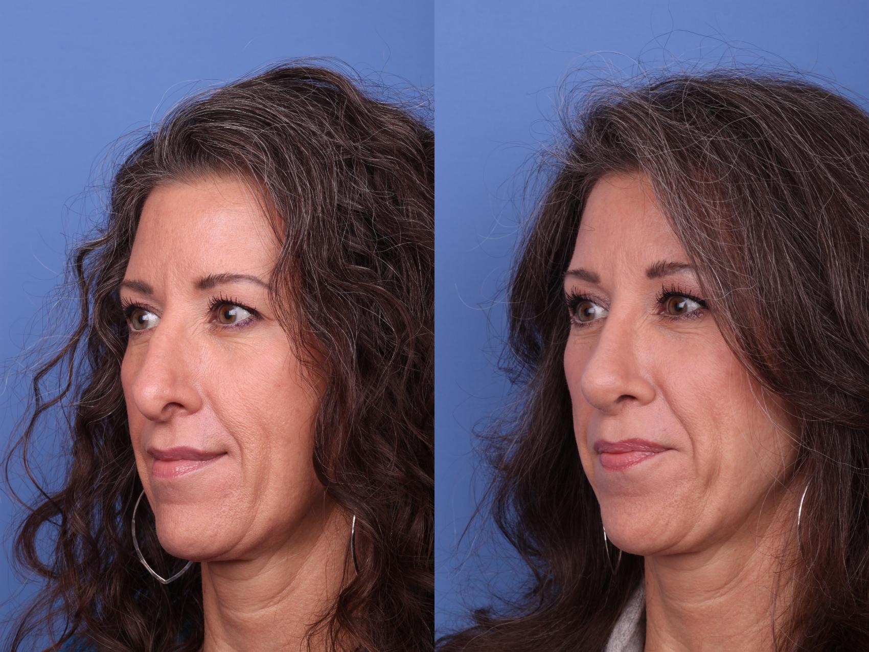 Before & After Rhinoplasty Revision Case 551 Left Oblique View in Scottsdale, AZ