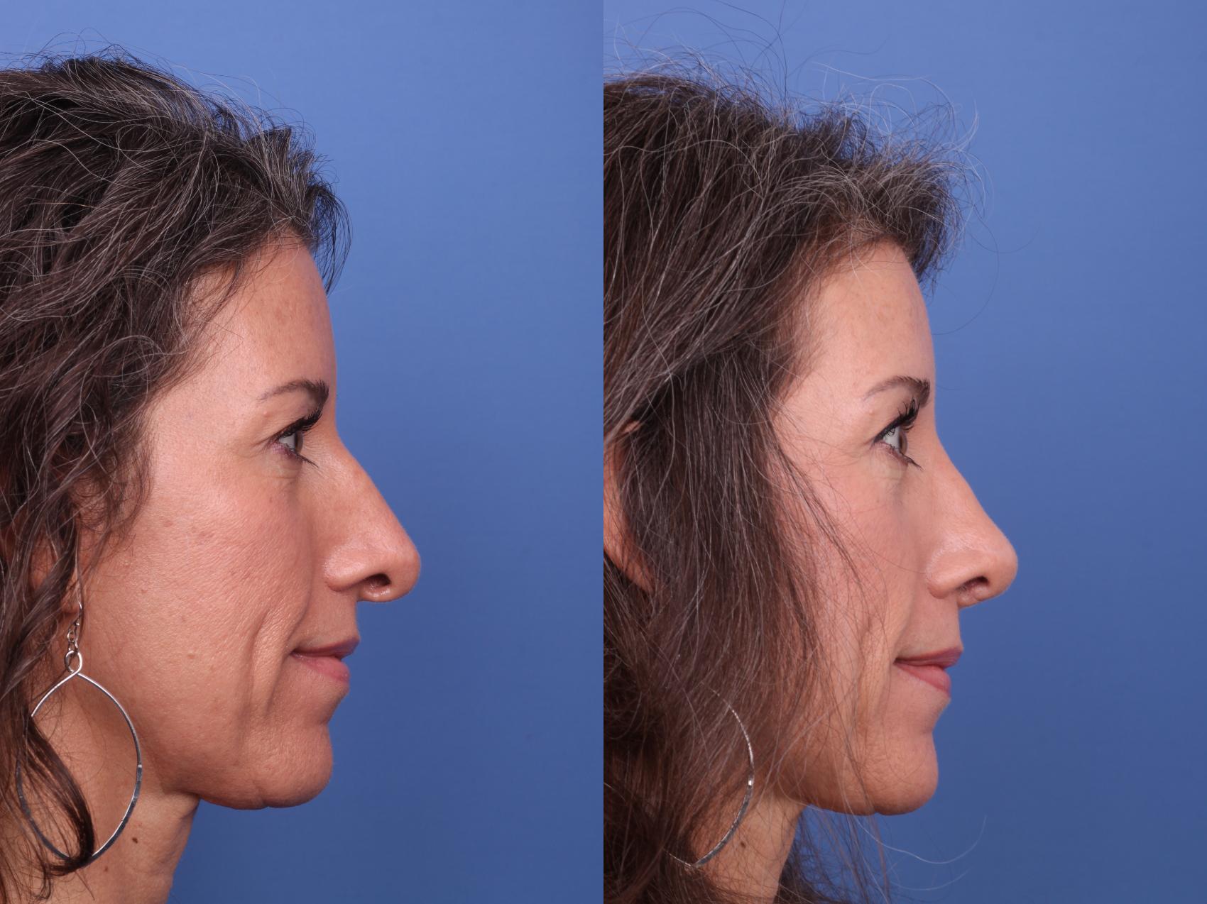 Before & After Rhinoplasty Revision Case 551 Right Side View in Scottsdale, AZ