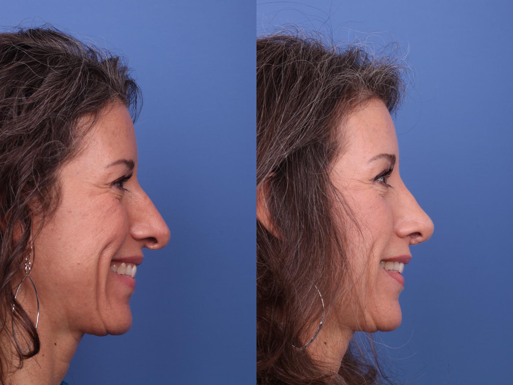 Before & After Rhinoplasty Revision Case 551 Right Smile View in Scottsdale, AZ