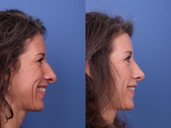 Rhinoplasty Revision Before & After Photo | Scottsdale & Phoenix, AZ | Hobgood Facial Plastic Surgery: Todd Hobgood, MD