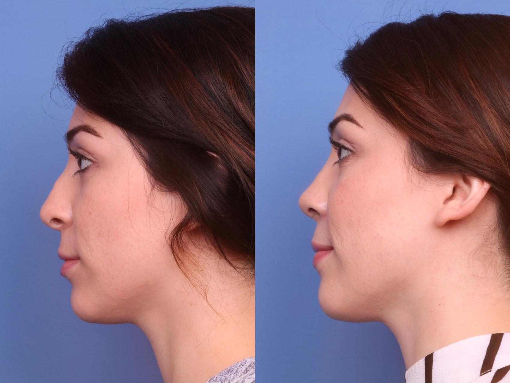 Before & After Rhinoplasty Revision Case 69 View #2 View in Scottsdale, AZ