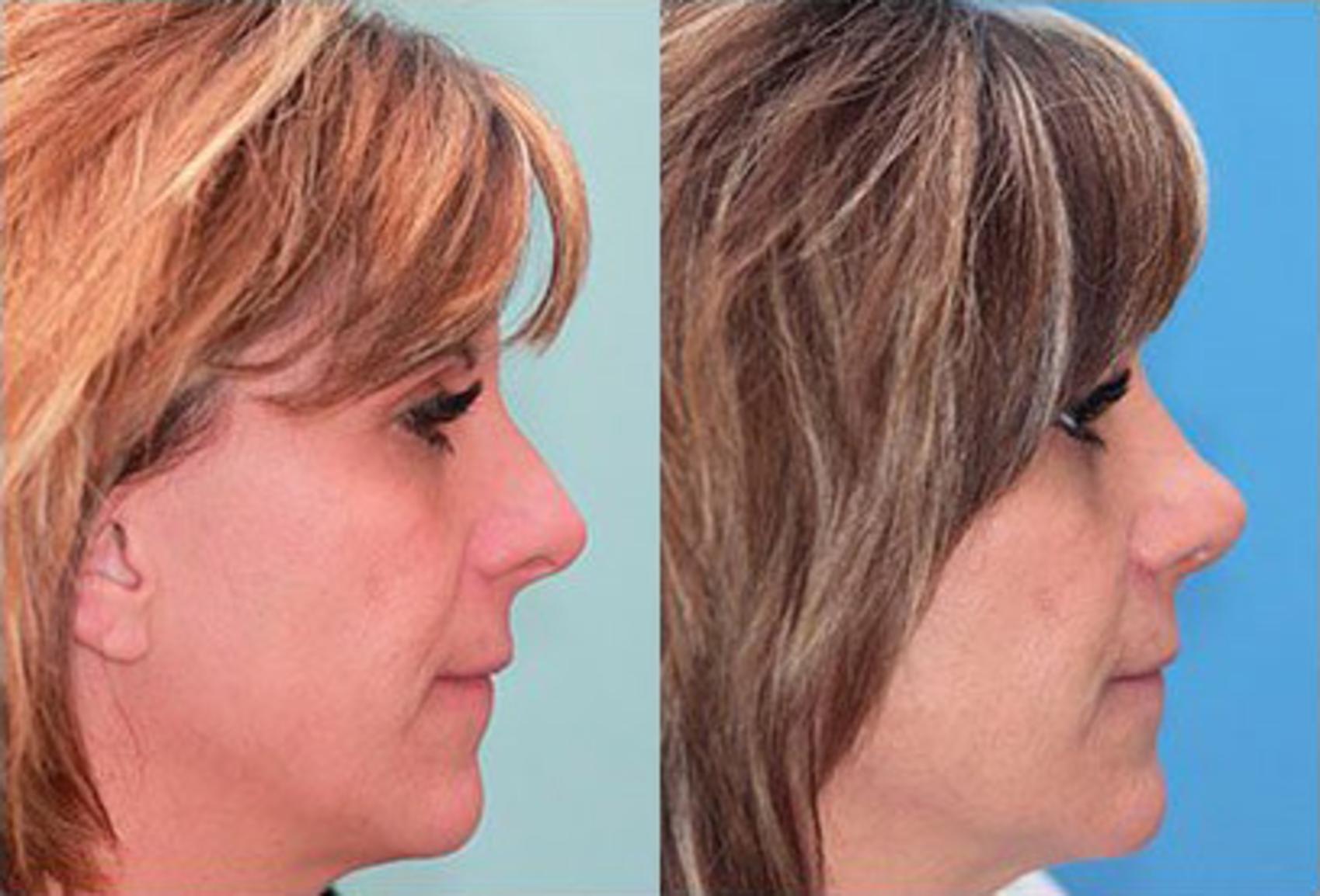 Before & After Rhinoplasty Revision Case 70 View #2 View in Scottsdale, AZ