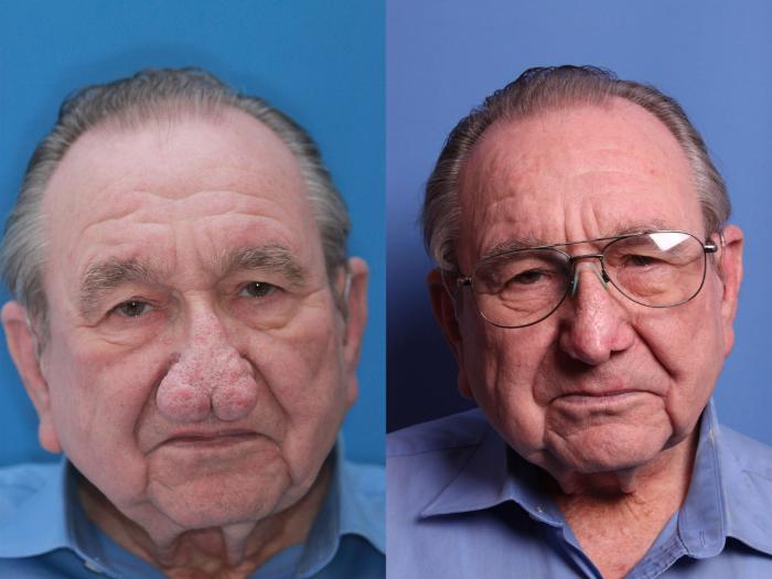 Rhynophyma Dermabrasion Before & After Photo | Scottsdale & Phoenix, AZ | Hobgood Facial Plastic Surgery: Todd Hobgood, MD