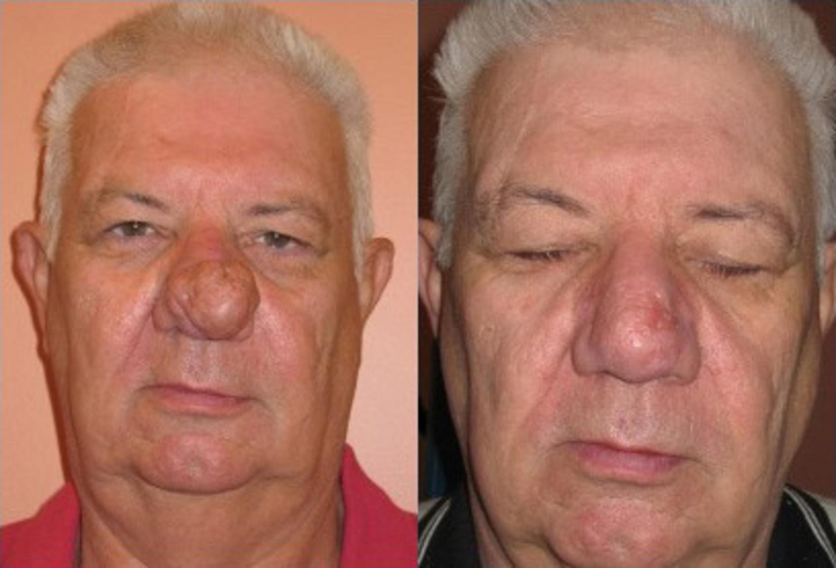 Rhynophyma Dermabrasion Before & After Photo | Scottsdale, AZ | Hobgood Facial Plastic Surgery: Todd Hobgood, MD