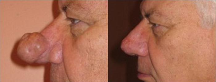 Rhynophyma Dermabrasion Before & After Photo | Scottsdale & Phoenix, AZ | Hobgood Facial Plastic Surgery: Todd Hobgood, MD