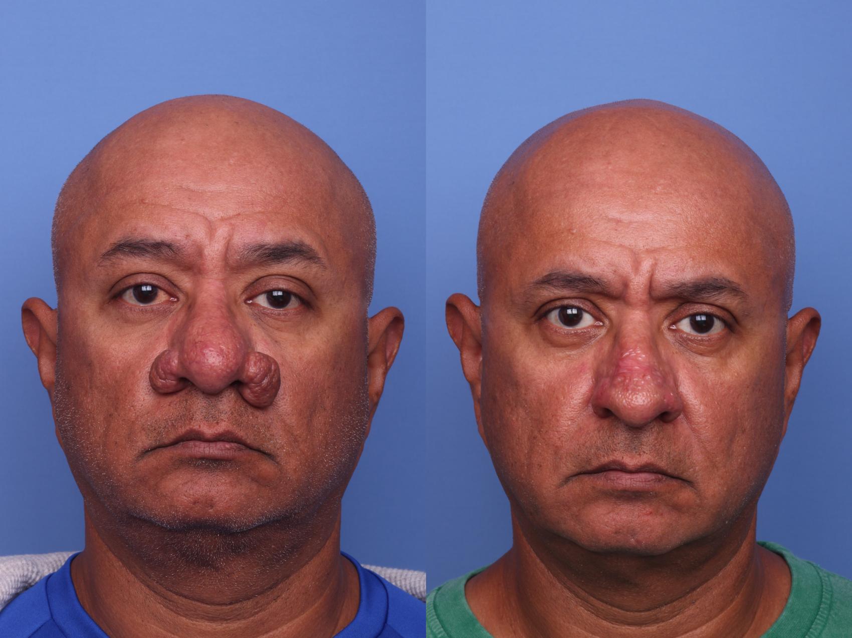 Rhynophyma Dermabrasion Before & After Photo | Scottsdale, AZ | Hobgood Facial Plastic Surgery: Todd Hobgood, MD