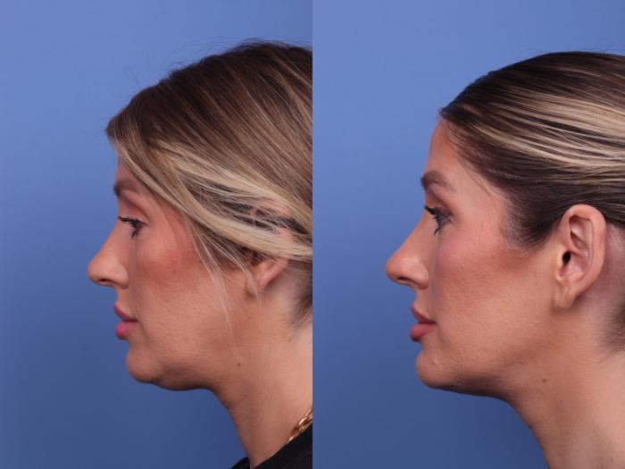 Submental Liposuction Before & After Photo | Scottsdale & Phoenix, AZ | Hobgood Facial Plastic Surgery: Todd Hobgood, MD