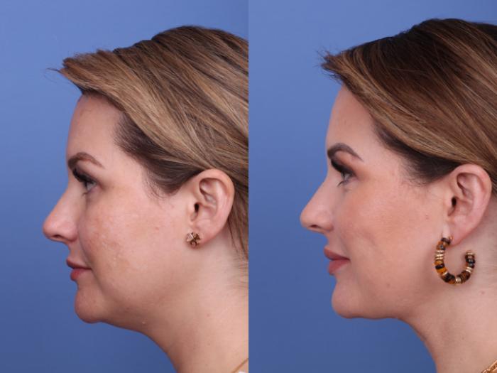 Submental Liposuction Before & After Photo | Scottsdale & Phoenix, AZ | Hobgood Facial Plastic Surgery: Todd Hobgood, MD