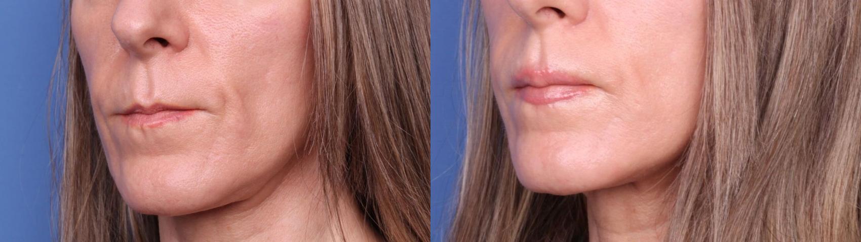 Surgical Lip Enhancement Before & After Photo | Scottsdale, AZ | Hobgood Facial Plastic Surgery: Todd Hobgood, MD