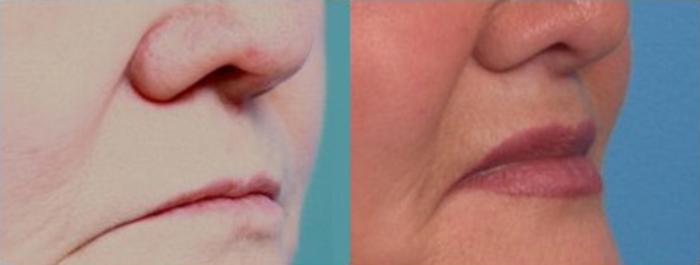 Surgical Lip Enhancement Before & After Photo | Scottsdale & Phoenix, AZ | Hobgood Facial Plastic Surgery: Todd Hobgood, MD