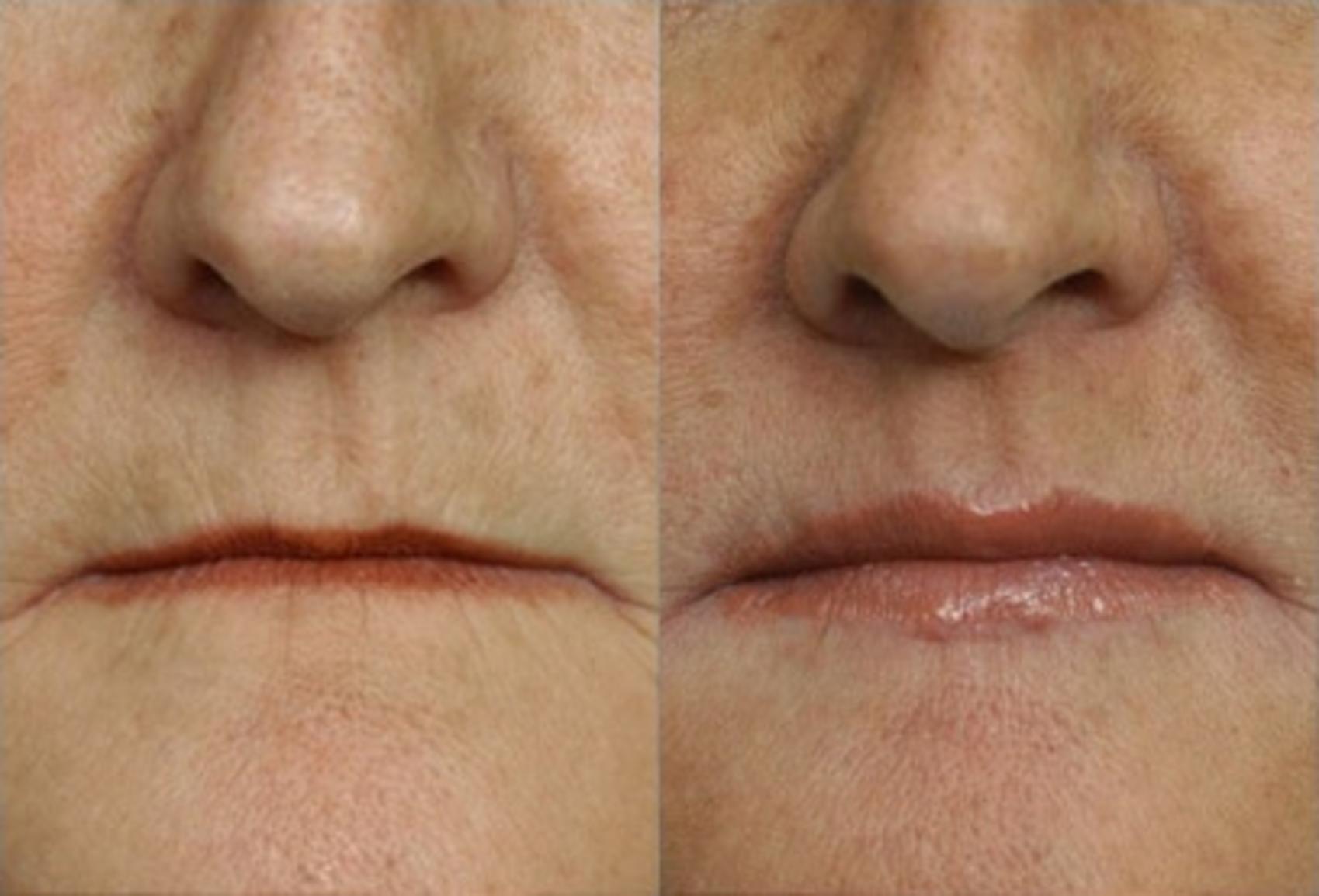 Surgical Lip Enhancement Before And After Pictures Case 118 
