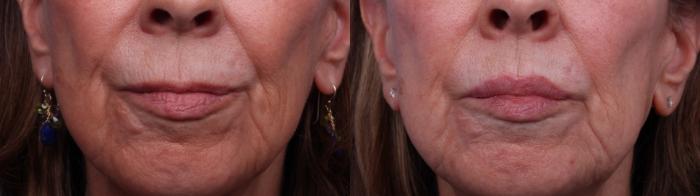 Surgical Lip Enhancement Before & After Photo | Scottsdale & Phoenix, AZ | Hobgood Facial Plastic Surgery: Todd Hobgood, MD