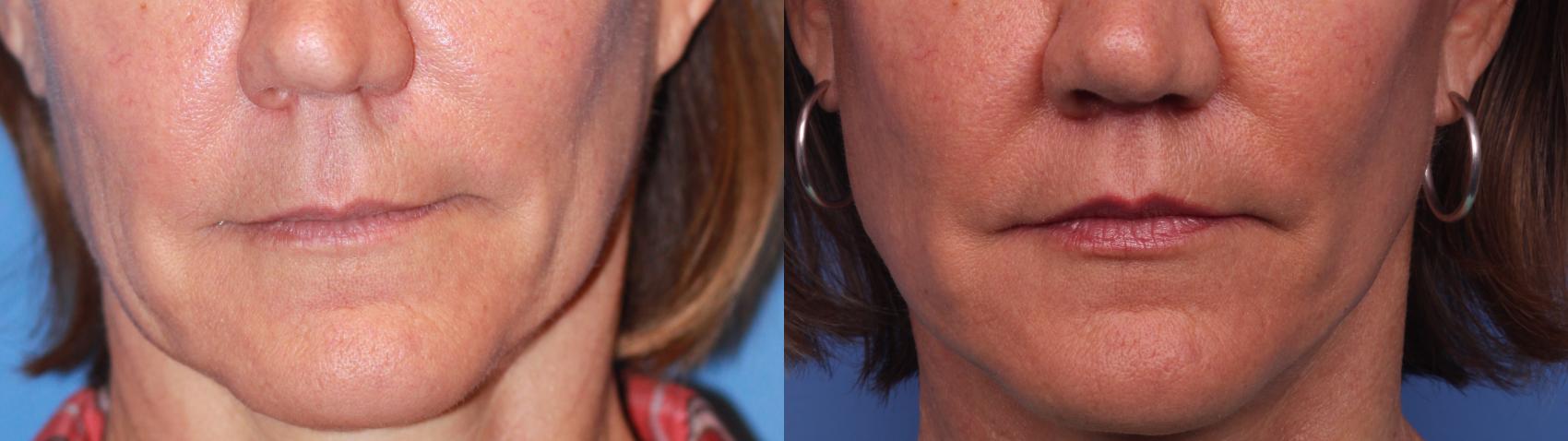 Surgical Lip Enhancement Before & After Photo | Scottsdale & Phoenix, AZ | Hobgood Facial Plastic Surgery: Todd Hobgood, MD