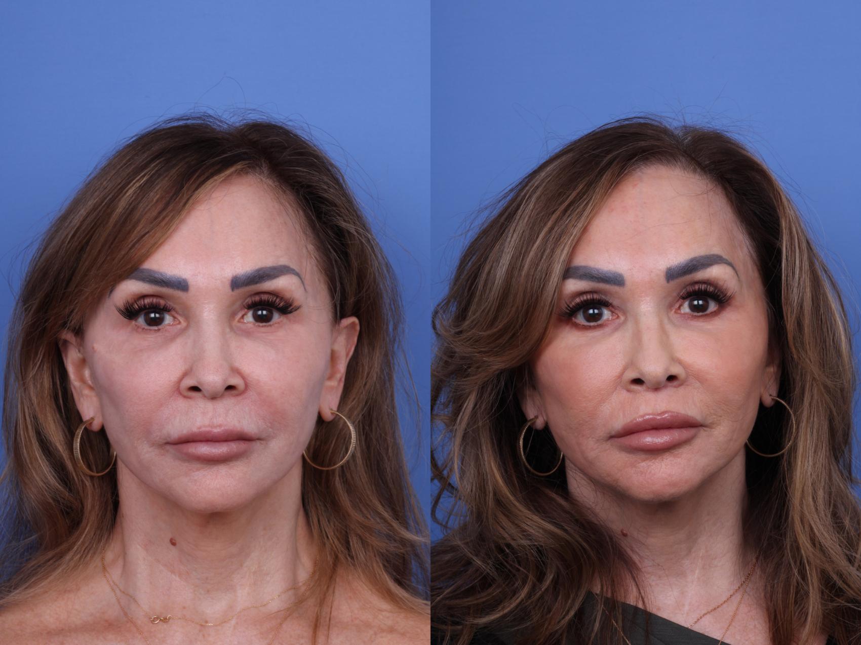Before & After Surgical Lip Enhancement Case 705 Front View in Scottsdale, AZ