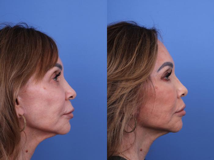 Before & After Surgical Lip Enhancement Case 705 Right Side View in Scottsdale, AZ