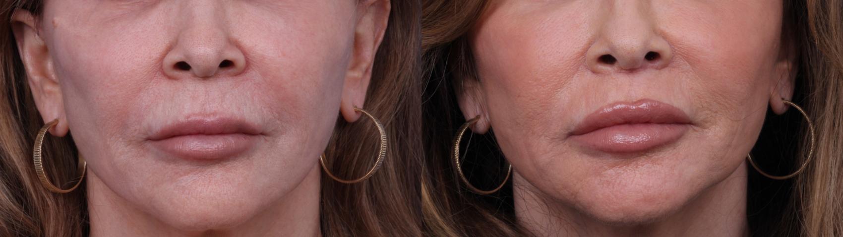 Before & After Surgical Lip Enhancement Case 705 Zoom Lip Lift View in Scottsdale, AZ