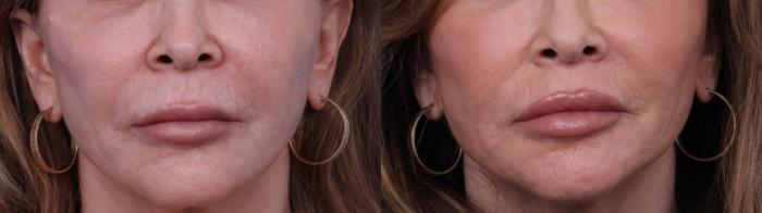 Before & After Surgical Lip Enhancement Case 705 Zoom Lip Lift View in Scottsdale, AZ